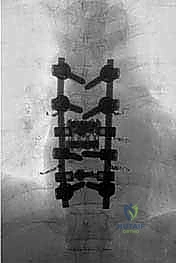 صورة توضيحية لـ استئصال الفقرة بالكامل ككتلة واحدة: ريادة الأستاذ الدكتور محمد هطيف في جراحة العمود الفقري المعقدة بصنعاء