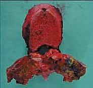 صورة طبية: استئصال الفقرة بالكامل ككتلة واحدة: ريادة الأستاذ الدكتور محمد هطيف في جراحة العمود الفقري المعقدة بصنعاء