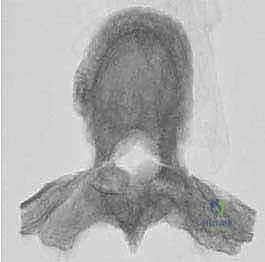 صورة طبية: استئصال الفقرة بالكامل ككتلة واحدة: ريادة الأستاذ الدكتور محمد هطيف في جراحة العمود الفقري المعقدة بصنعاء