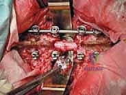 صورة طبية: استئصال الفقرة بالكامل ككتلة واحدة: ريادة الأستاذ الدكتور محمد هطيف في جراحة العمود الفقري المعقدة بصنعاء