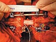 صورة توضيحية لـ استئصال الفقرة بالكامل ككتلة واحدة: ريادة الأستاذ الدكتور محمد هطيف في جراحة العمود الفقري المعقدة بصنعاء