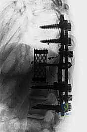 صورة طبية: استئصال الفقرة بالكامل ككتلة واحدة: ريادة الأستاذ الدكتور محمد هطيف في جراحة العمود الفقري المعقدة بصنعاء