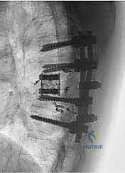 صورة طبية: استئصال الفقرة بالكامل ككتلة واحدة: ريادة الأستاذ الدكتور محمد هطيف في جراحة العمود الفقري المعقدة بصنعاء