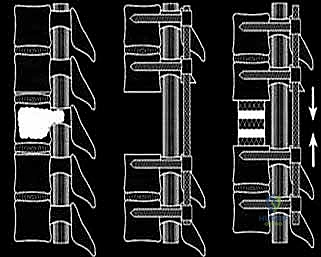 صورة توضيحية لـ استئصال الفقرة بالكامل ككتلة واحدة: ريادة الأستاذ الدكتور محمد هطيف في جراحة العمود الفقري المعقدة بصنعاء