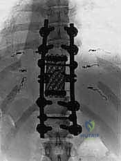 التحرير الأمامي وفصل الأوعية الدموية