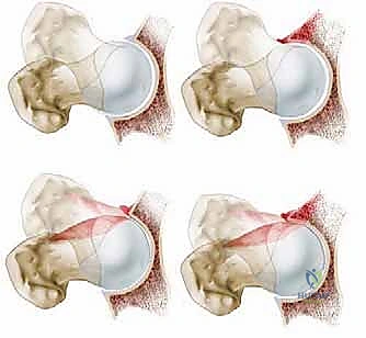 Illustration of anterolateral femoral headneck - Dr. Mohammed Hutaif