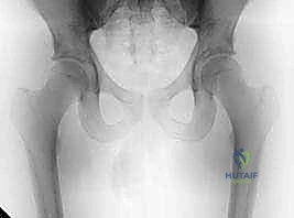 تشريح مفصل الورك الطبيعي