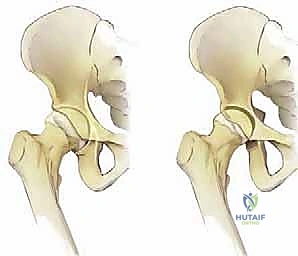 الغضروف والشفا الحقي في مفصل الورك