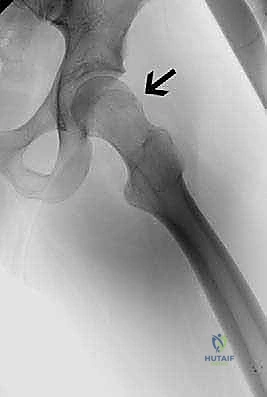 آلية حدوث انحشار الورك الفخذي