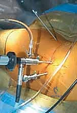 التشخيص السريري لانحشار الورك