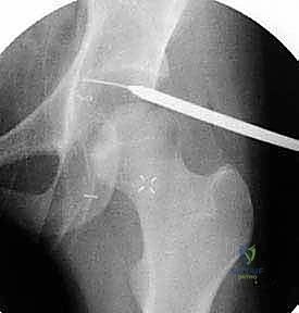 أعراض متلازمة انحشار الورك الفخذي