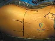 أسباب وعوامل خطر الإصابة بانحشار الورك