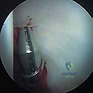 انحشار الورك من نوع كماشة Pincer