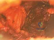 صورة توضيحية لـ علاج متلازمة انحشار الورك الفخذي الأمامي عبر شق أمامي: دليل شامل للمرضى