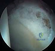 صورة توضيحية لـ علاج متلازمة انحشار الورك الفخذي الأمامي عبر شق أمامي: دليل شامل للمرضى