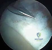 علاج متلازمة انحشار الورك الفخذي الأمامي عبر شق أمامي: دليل شامل للمرضى