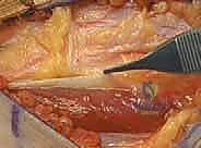 صورة توضيحية لـ علاج متلازمة انحشار الورك الفخذي الأمامي عبر شق أمامي: دليل شامل للمرضى