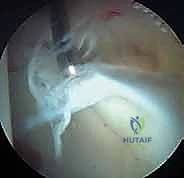 التصوير بالرنين المغناطيسي لمفصل الورك