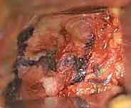 صورة توضيحية لـ علاج متلازمة انحشار الورك الفخذي الأمامي عبر شق أمامي: دليل شامل للمرضى