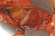 صورة طبية: علاج متلازمة انحشار الورك الفخذي الأمامي عبر شق أمامي: دليل شامل للمرضى