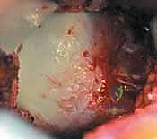 صورة توضيحية لـ علاج متلازمة انحشار الورك الفخذي الأمامي عبر شق أمامي: دليل شامل للمرضى