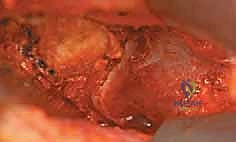 صورة طبية: علاج متلازمة انحشار الورك الفخذي الأمامي عبر شق أمامي: دليل شامل للمرضى