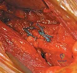 صورة طبية: علاج متلازمة انحشار الورك الفخذي الأمامي عبر شق أمامي: دليل شامل للمرضى