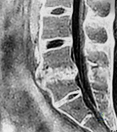 تحضيرات دقيقة قبل جراحة العمود الفقري