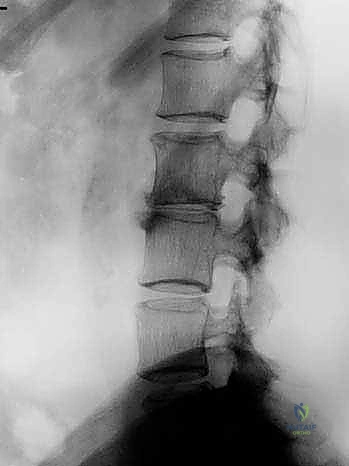 التشريح الدقيق للفقرات القطنية