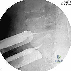صورة توضيحية لـ دمج الفقرات القطنية الأمامي واستئصال الجسم الفقري: حلول متقدمة لآلام الظهر المزمنة مع الأستاذ الدكتور محمد هطيف في صنعاء