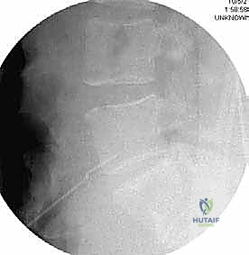 الوصول الجراحي للفقرة المصابة