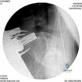 صورة توضيحية لـ دمج الفقرات القطنية الأمامي واستئصال الجسم الفقري: حلول متقدمة لآلام الظهر المزمنة مع الأستاذ الدكتور محمد هطيف في صنعاء