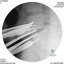 صورة طبية: دمج الفقرات القطنية الأمامي واستئصال الجسم الفقري: حلول متقدمة لآلام الظهر المزمنة مع الأستاذ الدكتور محمد هطيف في صنعاء