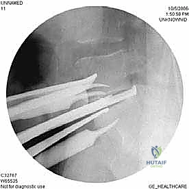 التثبيت الشامل للعمود الفقري بعد الاستئصال