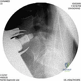 التعامل الدقيق مع الأوعية الدموية الكبرى