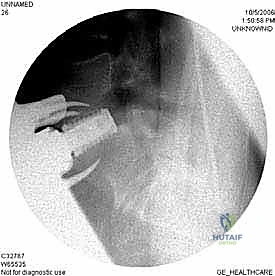 صورة طبية: دمج الفقرات القطنية الأمامي واستئصال الجسم الفقري: حلول متقدمة لآلام الظهر المزمنة مع الأستاذ الدكتور محمد هطيف في صنعاء