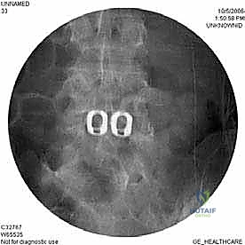 إدخال القفص الداعم بين الفقرات