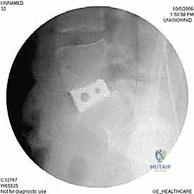 صورة توضيحية لـ دمج الفقرات القطنية الأمامي واستئصال الجسم الفقري: حلول متقدمة لآلام الظهر المزمنة مع الأستاذ الدكتور محمد هطيف في صنعاء