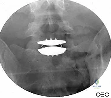 شرح النهج الأمامي للعمود الفقري