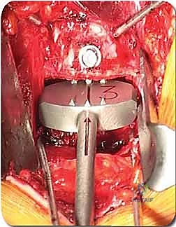 صورة طبية: دمج الفقرات القطنية الأمامي واستئصال الجسم الفقري: حلول متقدمة لآلام الظهر المزمنة مع الأستاذ الدكتور محمد هطيف في صنعاء