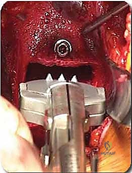 دمج الفقرات القطنية الأمامي واستئصال الجسم الفقري: حلول متقدمة لآلام الظهر المزمنة مع الأستاذ الدكتور محمد هطيف في صنعاء