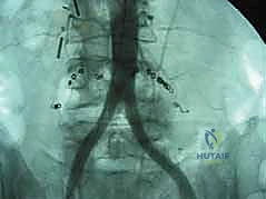 صورة توضيحية لـ دمج الفقرات القطنية الأمامي واستئصال الجسم الفقري: حلول متقدمة لآلام الظهر المزمنة مع الأستاذ الدكتور محمد هطيف في صنعاء