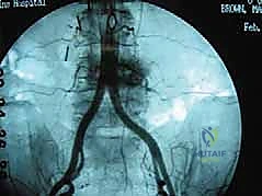 صورة شعاعية تؤكد نجاح التثبيت