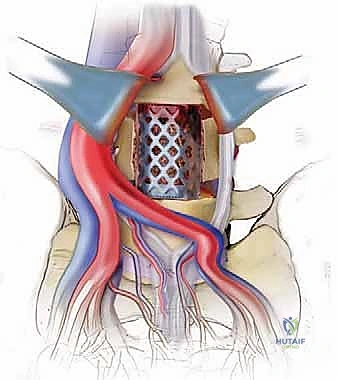 صورة توضيحية لـ دمج الفقرات القطنية الأمامي واستئصال الجسم الفقري: حلول متقدمة لآلام الظهر المزمنة مع الأستاذ الدكتور محمد هطيف في صنعاء