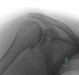 تآكل الغضروف وتكون النتوءات العظمية في الكتف