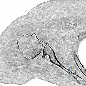 العلاجات التحفظية لخشونة الكتف