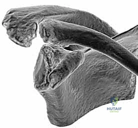 تصلب ومحدودية حركة الكتف بسبب الخشونة