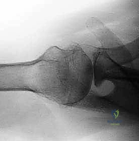 التشريح الدقيق لمفصل الكتف والتجويف الحقاني