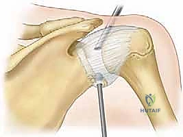 تجهيز المريض لجراحة تنظير الكتف