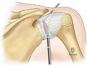 تحرير المحفظة المفصلية لاستعادة الحركة